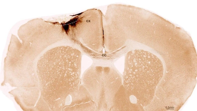 Ущерб от инсульта обратили с помощью стволовых клеток